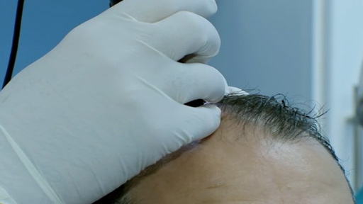 "ثورة" يابانية في زراعة الشعر