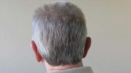 علاج للسرطان يثير حيرة العلماء ويعيد للشعر لونه الأسود