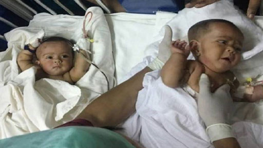 أول عملية ناجحة لفصل توأمين سياميين في بنغلاديش