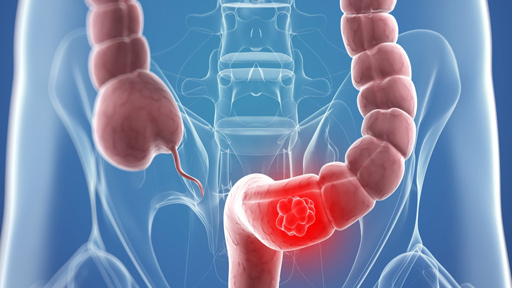 ندوة توعية عن سرطان القولون في بلدة الخريبة المتنية