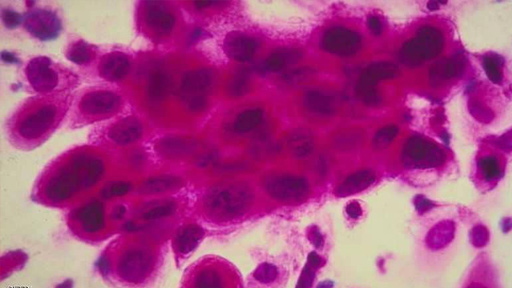 السرطان في يومه العالمي.. حقائق وأرقام "مفزعة"